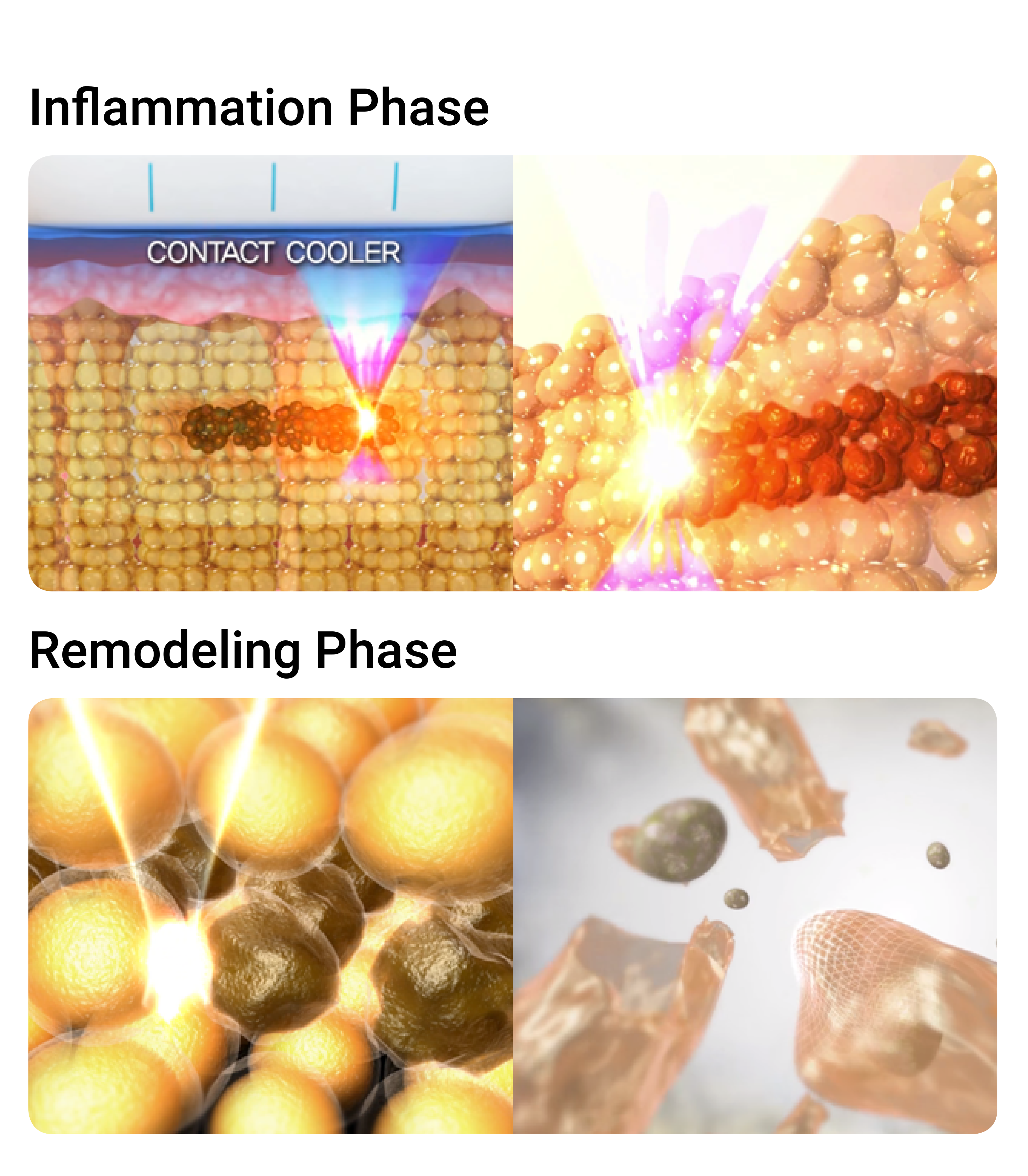 Inflammation and Remodeling Phase