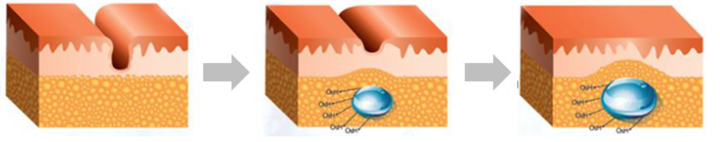 Cutegel Hydro Treatment Procedure