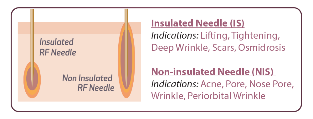 Ensemble Needle Type