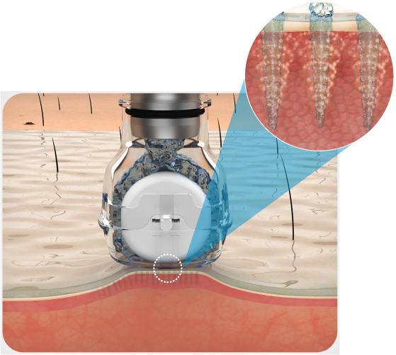 Transdermal Delivery Technology