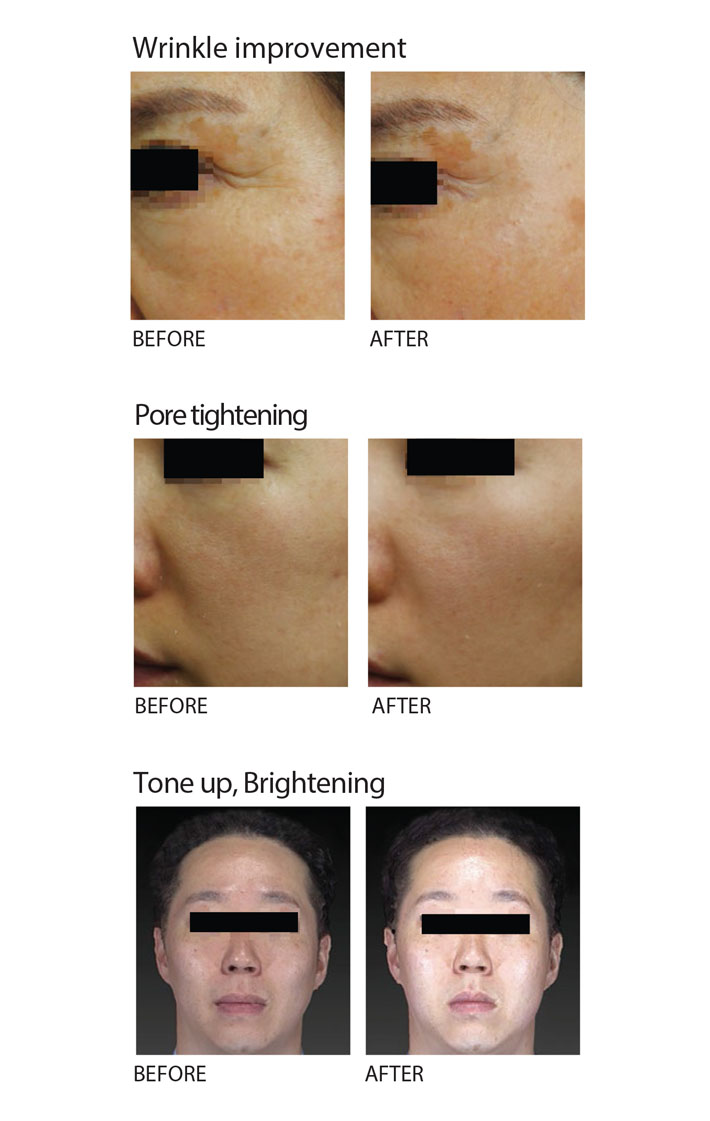 Before & After QT Cell