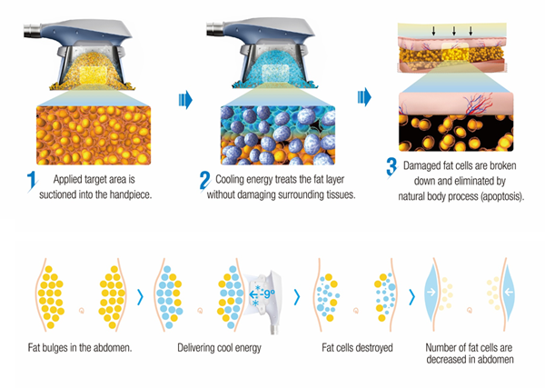 Mechanism of Freeze on Fat off