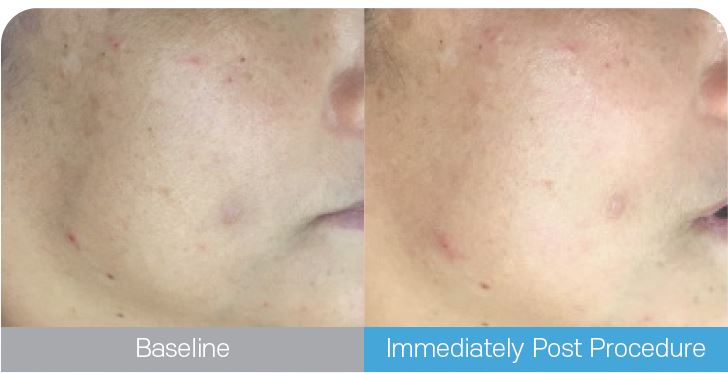 Aquapure II Clinical Case 2