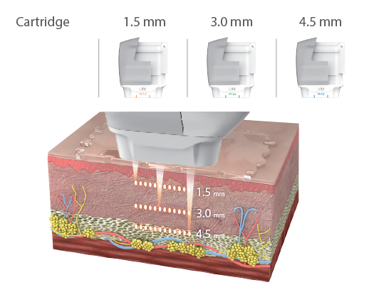 Ulfit Face Contouring